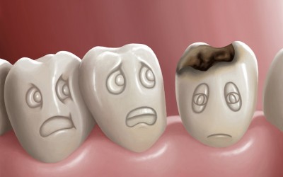 sobre la caries dental