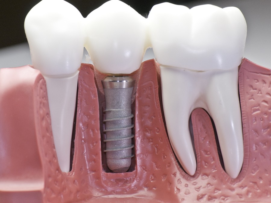 Implantes dentales, la mejor opción terapéutica para sustituir la pérdida de un diente